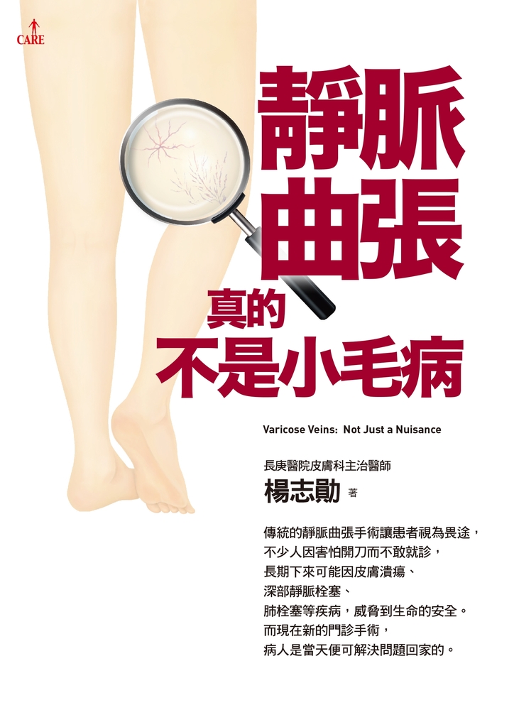 靜脈曲張,真的不是小毛病